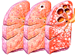 Scientists worry over Nigeria’s high TB burden