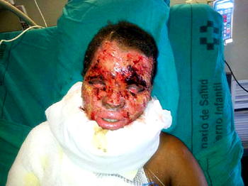 ‘Jealous wife of native doctor bathed me with acid’