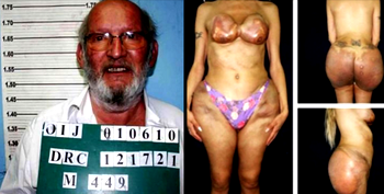 Faulty breast implant company founder faces jail in France
