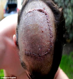 High levels of education linked to heightened brain tumour risk