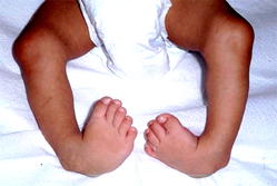 Clubfoot in children can be corrected- Dr. Olayinka Adegbehingbe
