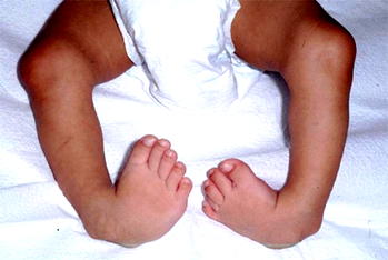 Clubfoot in children can be corrected- Dr. Olayinka Adegbehingbe