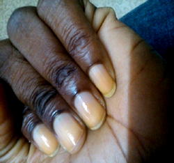 Common nail conditions that you shouldn’t ignore