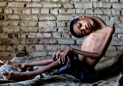 Boy whose head hung upside down undergoes surgery