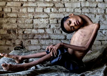 Boy whose head hung upside down undergoes surgery