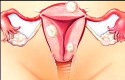 ENDOMETRIOSIS: ESGN targets 10,000 Nigerian women