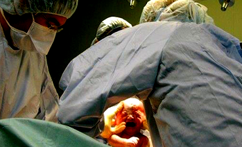 A Caesarean Section could be too much, too soon