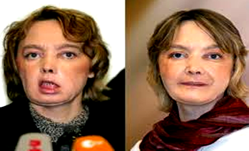 Frenchwoman who received first face transplant dies, says hospital