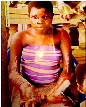 20-yr-old epileptic falls into fire, seeks help for N1.5m medical bill