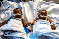 Kogi’s couple’s conjoined twins successfully separated in US
