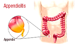 What you should know about appendicitis