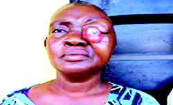 41-year-old mother requires N1.5m for eye surgery