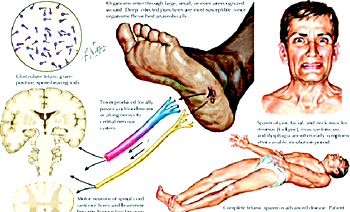 Medical expert urges public to take lifelong tetanus immunity vaccine