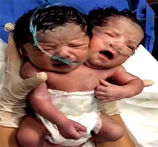 Conjoined twins share single body, two heads in Mexico