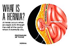Your hernia will not heal on its own