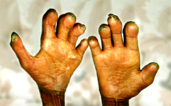 Reviving leprosy care in Nigeria