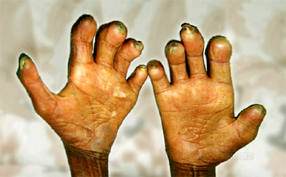 Leprosy curable if detected early — VOHAF