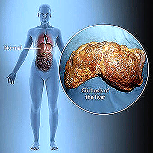 New drug, Kisspeptin , rekindles hope for liver disease patients