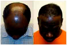 Why bald men are at greater risk or having  a heart disease – Bunmi Sofola