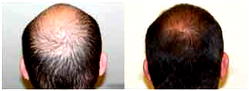 Shorter men more likely to go bald earlier