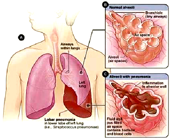 FG develops pneumonia control strategy — Minister