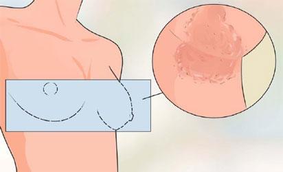 Common causes, signs, prevention tips for breast fungal infection