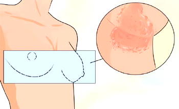 Common causes, signs, prevention tips for breast fungal infection