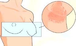 Common causes, signs, prevention tips for breast fungal infection