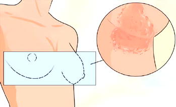 Common causes, signs, prevention tips for breast fungal infection