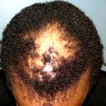 SHOCKING: Mans Terrible Bald Hair Almost Ruined His Career