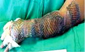 Burn patients: Tilapia skin to the rescue