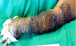 Burn patients: Tilapia skin to the rescue