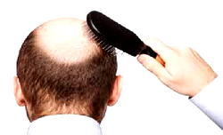 Shorter men more likely to go bald earlier