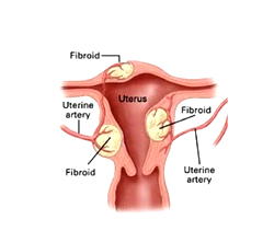 How I got rid of my fibroid without surgery