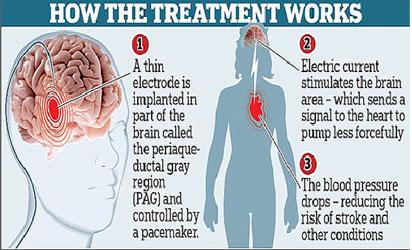 Blood Pressure and Your Brain 