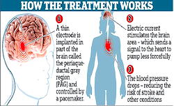 Doctors  lower blood  pressure with wire inside the brain
