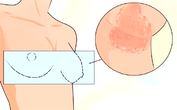 Common causes, signs, prevention tips for breast fungal infection