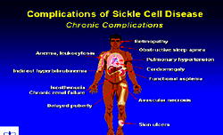 Experts seek full NHIS coverage for Sickle cell