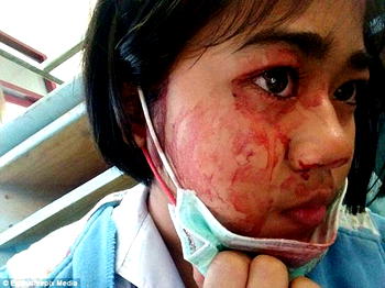Headache causes us to ‘sweat’ blood