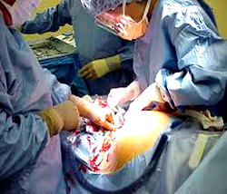 FG announces free C-Sections for Nigerian women