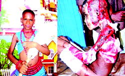 11 years old kerosene explosion victim cries out for help