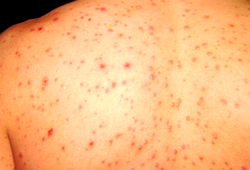 Chickenpox is contagious, be careful