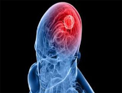 brain cancer image Hot tea linked to higher esophageal cancer risks