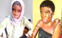 I still need 10,700 dollars lifeline – Lady badly burnt in police barracks by lover