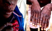 FG denies alleged deliberate injection of Monkey pox virus