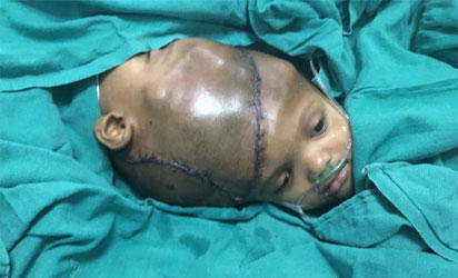 40 Indian doctors separate twins joined in the skull