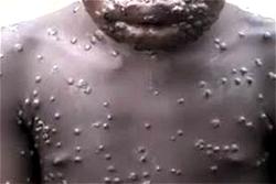Just in: Monkey pox reportedly hits Lagos, two cases recorded
