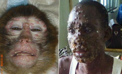 FG confirms 6 additional cases of Monkeypox – Gistmaster