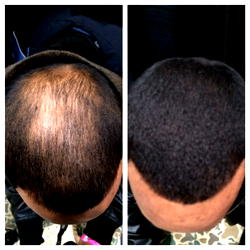 SHOCKING! Ex-Bald Haired Man Reveals Secret He Regrow His Bald Hair in 27 Days Without Spending His Life Saving on Hair Transplant Surgery