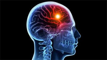 Experts worry as 200,000 Nigerians suffer stroke annually